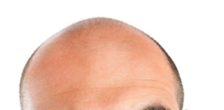 Čo robia ženy a mužom z toho vypadávajú vlasy